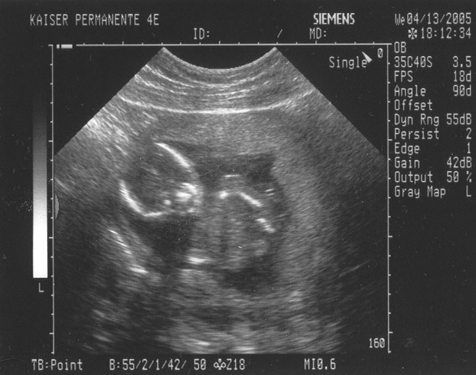 4/13/2005 ultrasound