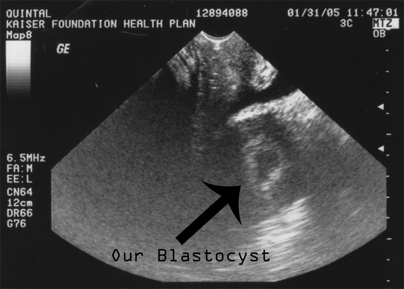 Our Blastocyst